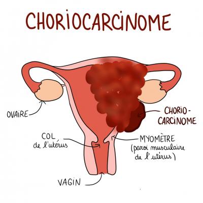 Choriocarcinome